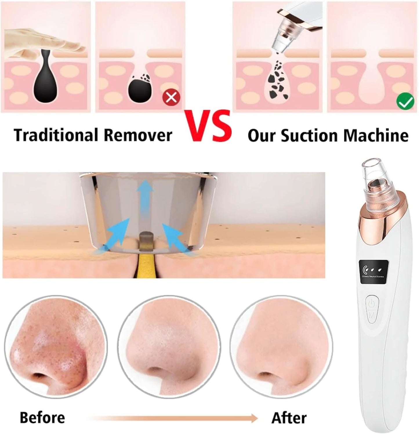 2024 Blackhead Remover Pore Vacuum,Facial Pore Cleaner-5 Suction Power,5 Probes,USB Rechargeable Blackhead Vacuum Kit Electric Acne Extractor Tool for Adult (White)